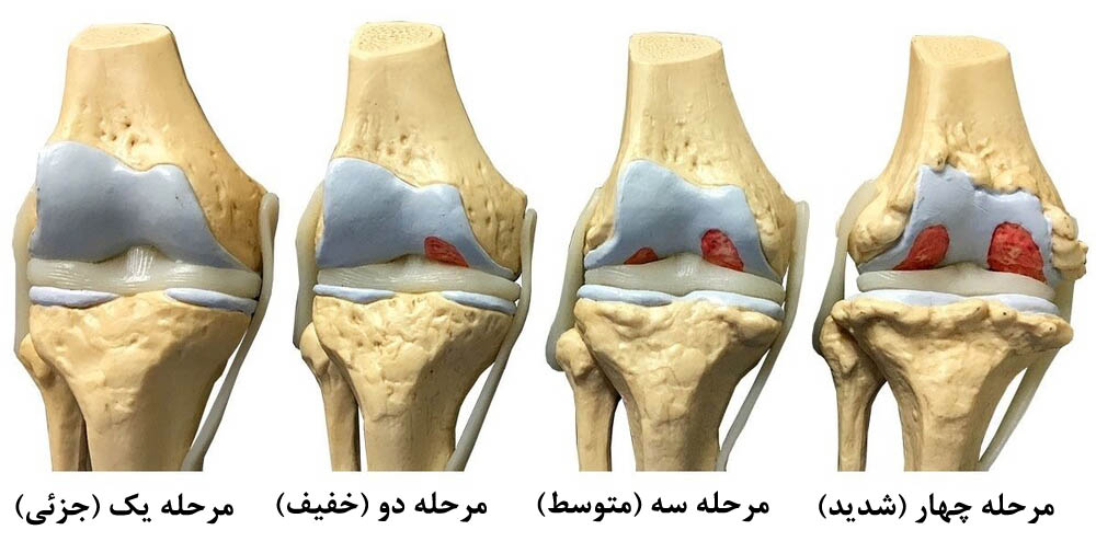 مراحل پیشرفت آرتروز زانو