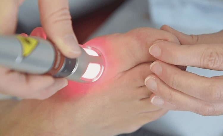درمان با لیزر سرد یا کم‌توان برای آرتروز شست پا