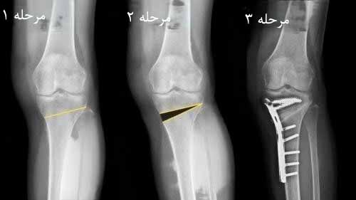 جراحی زانوی پرانتزی