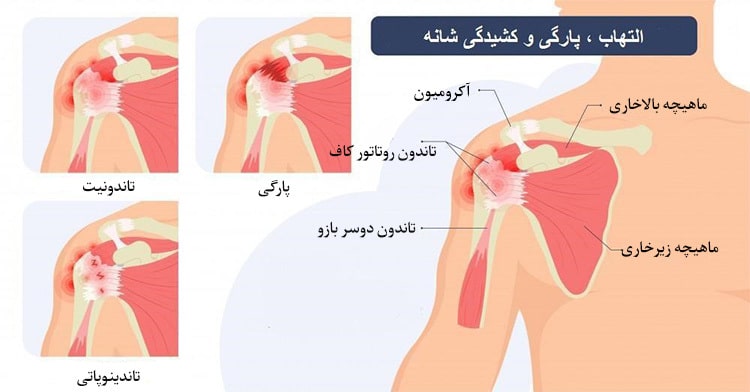 علت التهاب و پارگی تاندون شانه