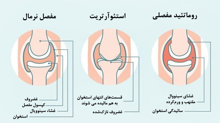 آرتروز