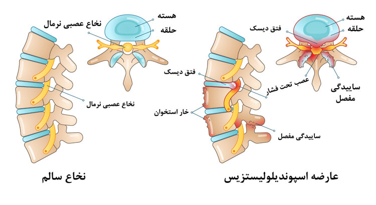 تنگی نخاع