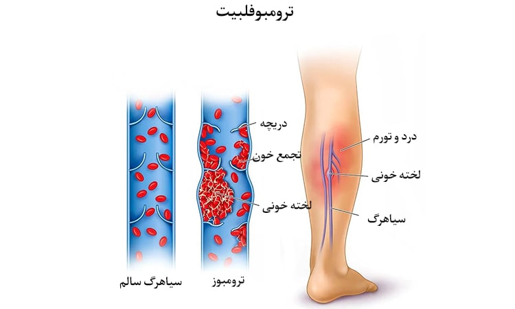 لخته‌های خونی