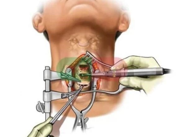 درمان دیسک گردن با جراحی